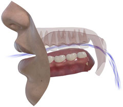 SNORS 3D • Oral hava akımı (yumuşak damak yukarı kalkmış)